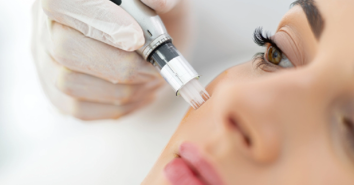 Woman Receiving Microneedling Treatment by True Bella Medical Aesthetics in Downey, CA